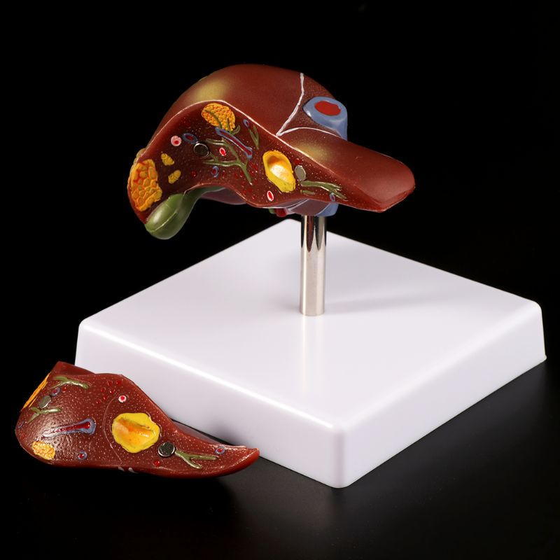 Medical Lab Assistant - Fegato umano Patologico Modello Anatomico Modello